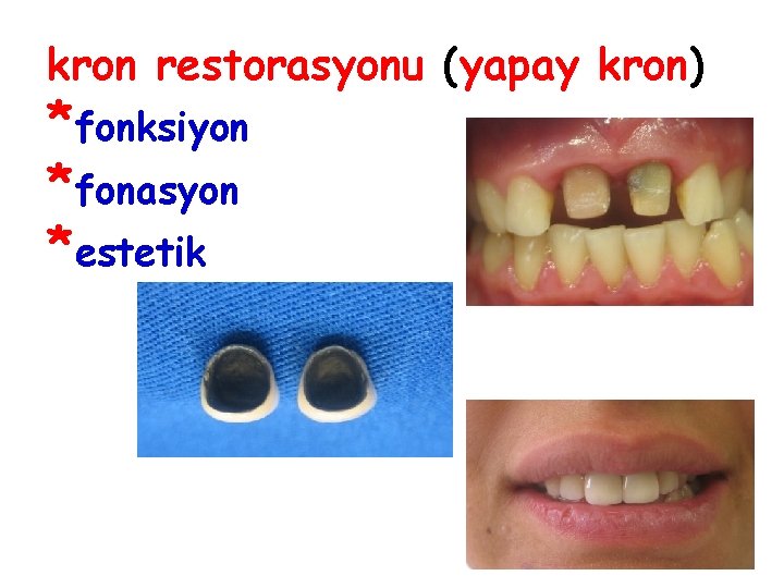 kron restorasyonu (yapay kron) *fonksiyon *fonasyon *estetik 