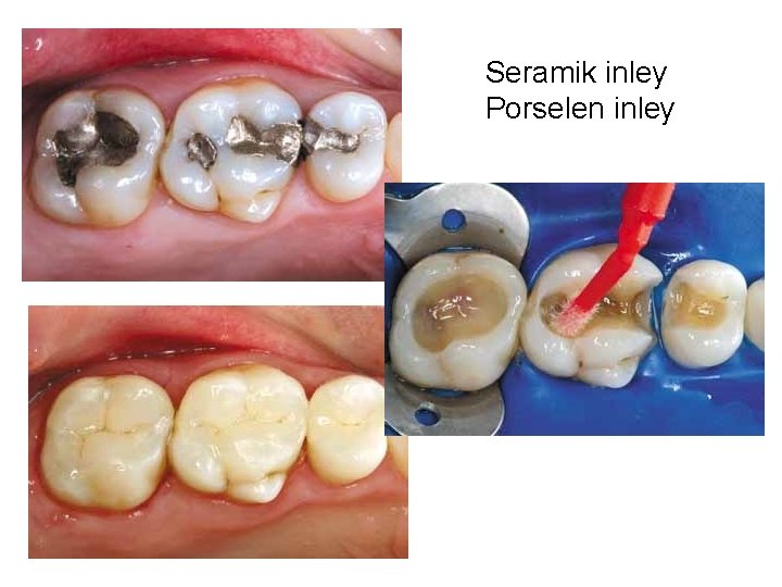 Seramik inley Porselen inley 