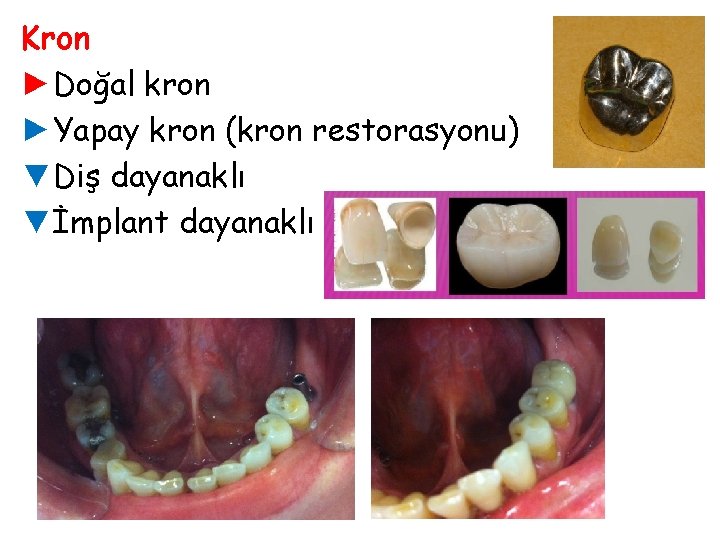 Kron ►Doğal kron ►Yapay kron (kron restorasyonu) ▼Diş dayanaklı ▼İmplant dayanaklı 