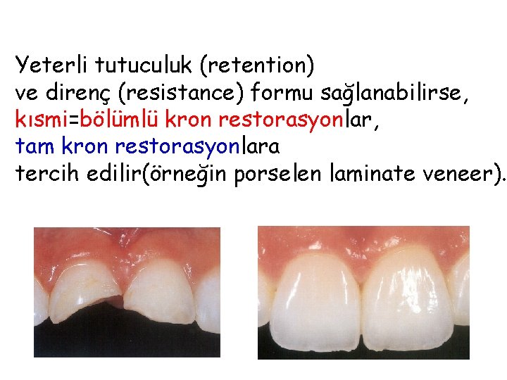 Yeterli tutuculuk (retention) ve direnç (resistance) formu sağlanabilirse, kısmi=bölümlü kron restorasyonlar, tam kron restorasyonlara