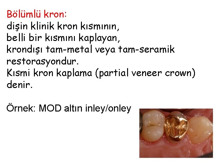 Bölümlü kron: dişin klinik kron kısmının, belli bir kısmını kaplayan, krondışı tam-metal veya tam-seramik