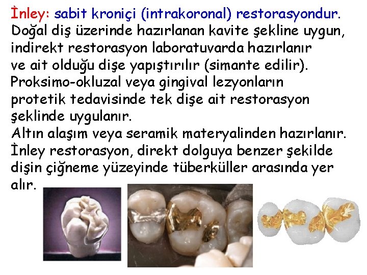 İnley: sabit kroniçi (intrakoronal) restorasyondur. Doğal diş üzerinde hazırlanan kavite şekline uygun, indirekt restorasyon