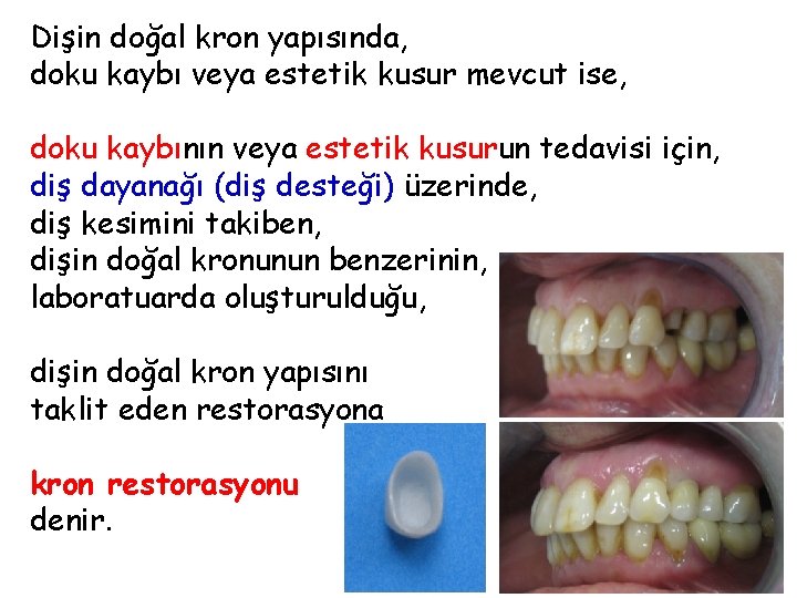 Dişin doğal kron yapısında, doku kaybı veya estetik kusur mevcut ise, doku kaybının veya