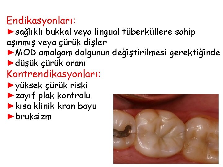 Endikasyonları: ►sağlıklı bukkal veya lingual tüberküllere sahip aşınmış veya çürük dişler ►MOD amalgam dolgunun