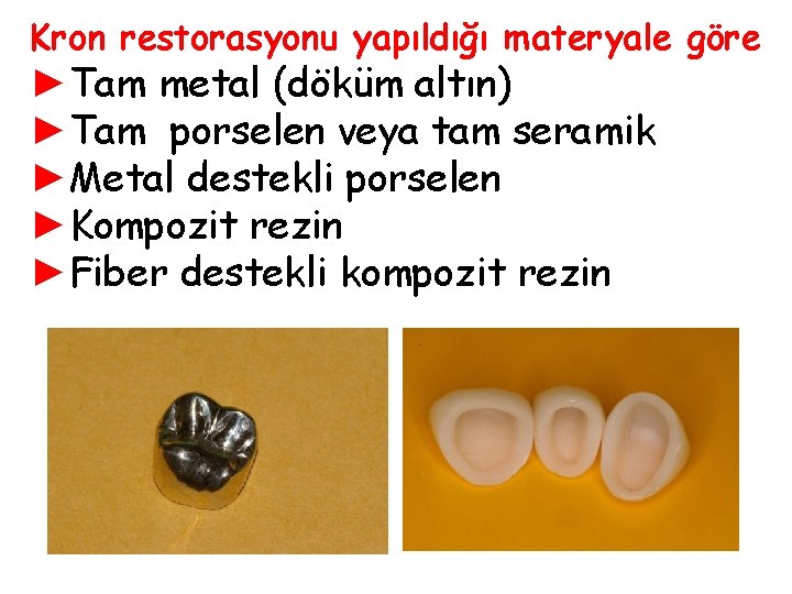 Kron restorasyonu yapıldığı materyale göre ►Tam metal (döküm altın) ►Tam porselen veya tam seramik