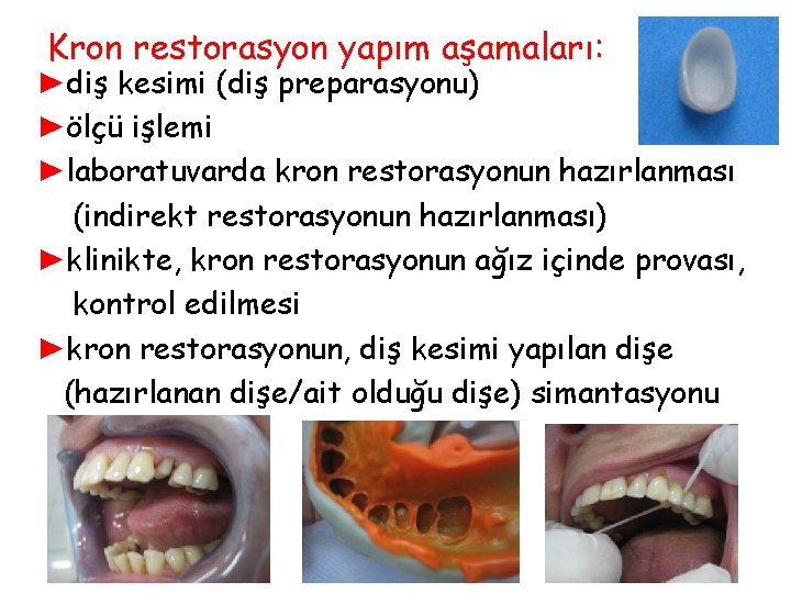 Kron restorasyon yapım aşamaları: ►diş kesimi (diş preparasyonu) ►ölçü işlemi ►laboratuvarda kron restorasyonun hazırlanması