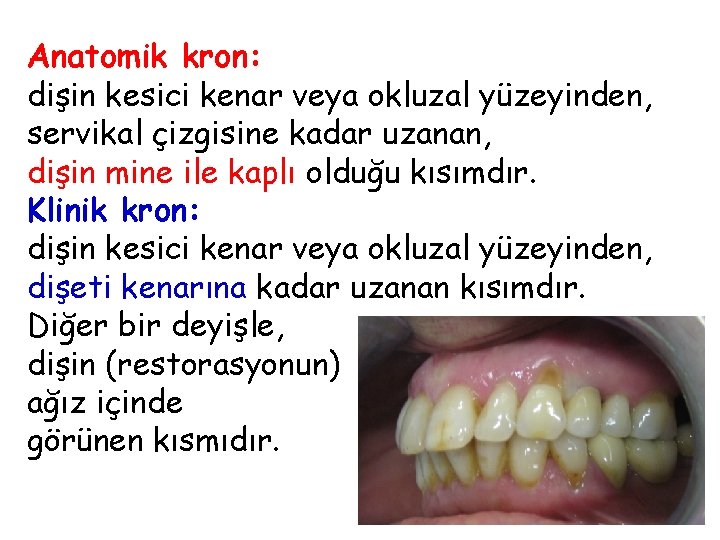 Anatomik kron: dişin kesici kenar veya okluzal yüzeyinden, servikal çizgisine kadar uzanan, dişin mine