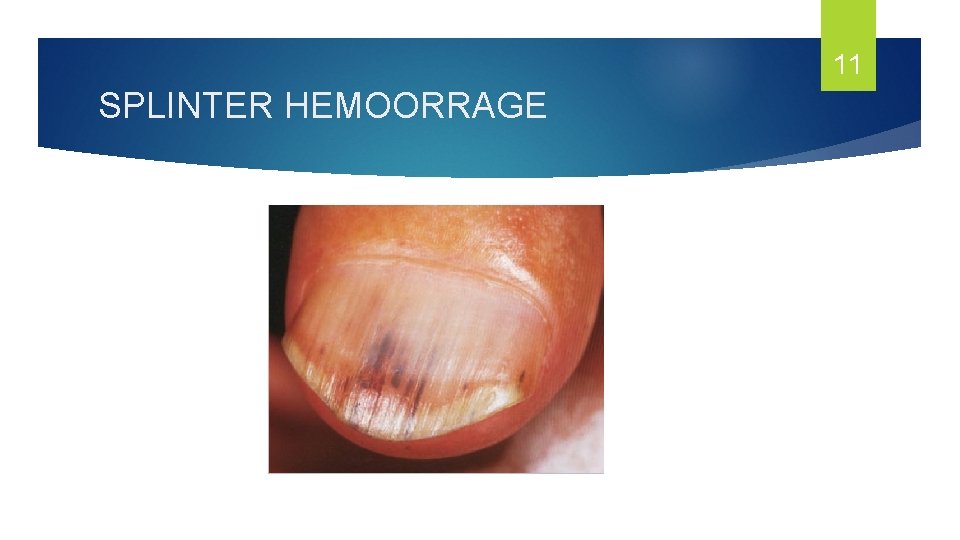 11 SPLINTER HEMOORRAGE 