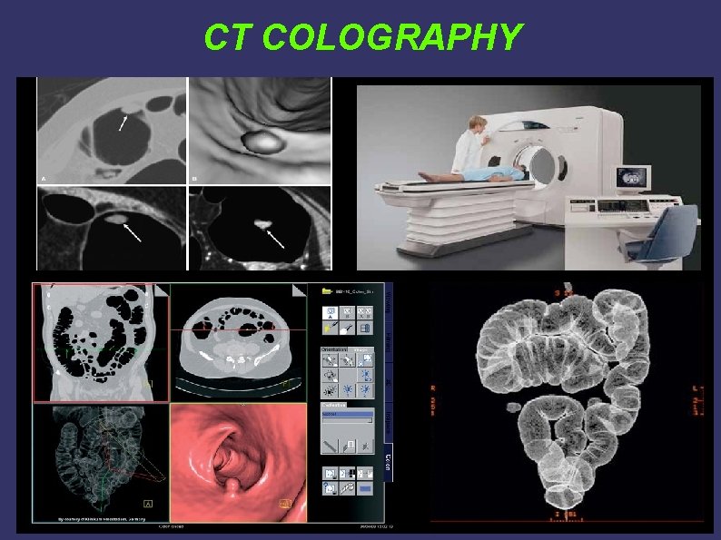 CT COLOGRAPHY CT COLOGRAPHY