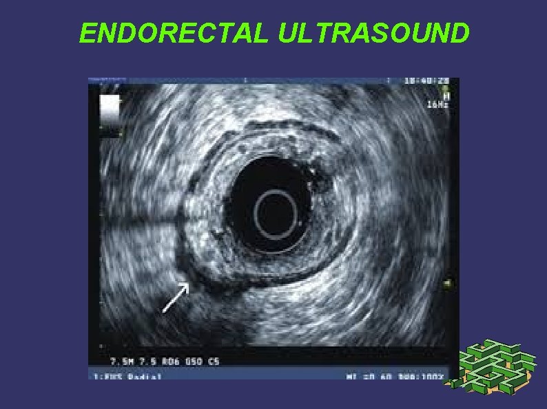 ENDORECTAL ULTRASOUND ENDORECTAL ULTRASOUND