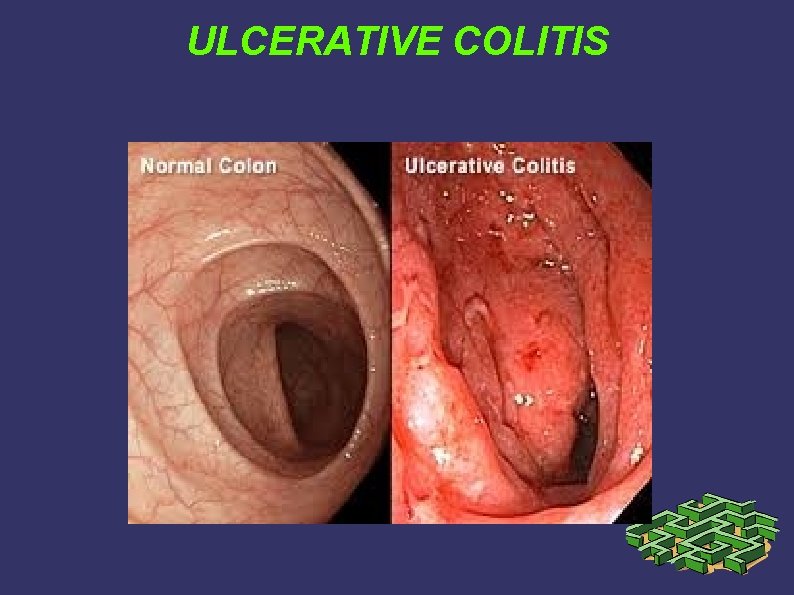 ULCERATIVE COLITIS ULCERATIVE COLITIS