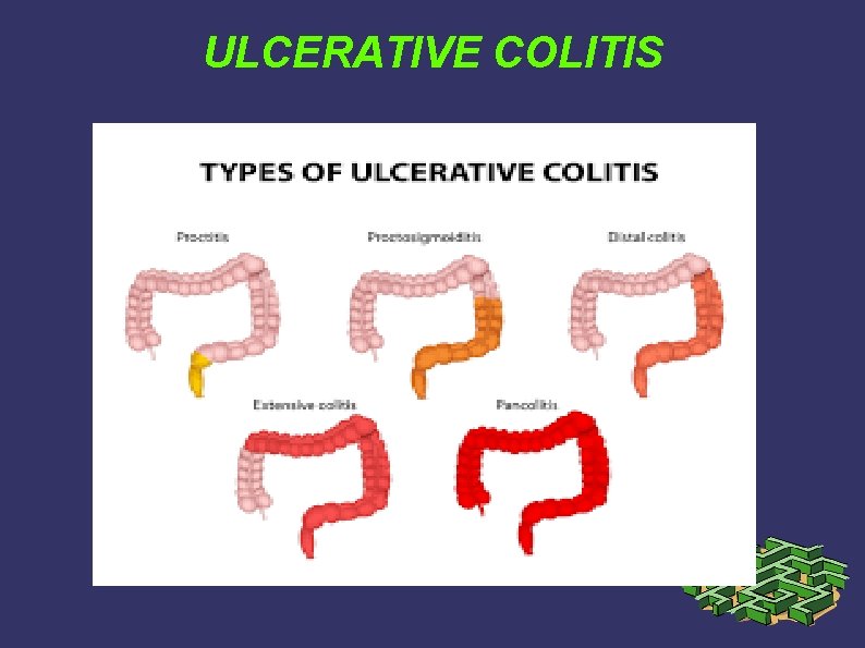 ULCERATIVE COLITIS ULCERATIVE COLITIS