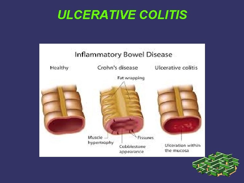 ULCERATIVE COLITIS ULCERATIVE COLITIS