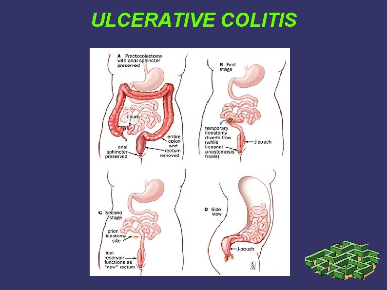 ULCERATIVE COLITIS ULCERATIVE COLITIS