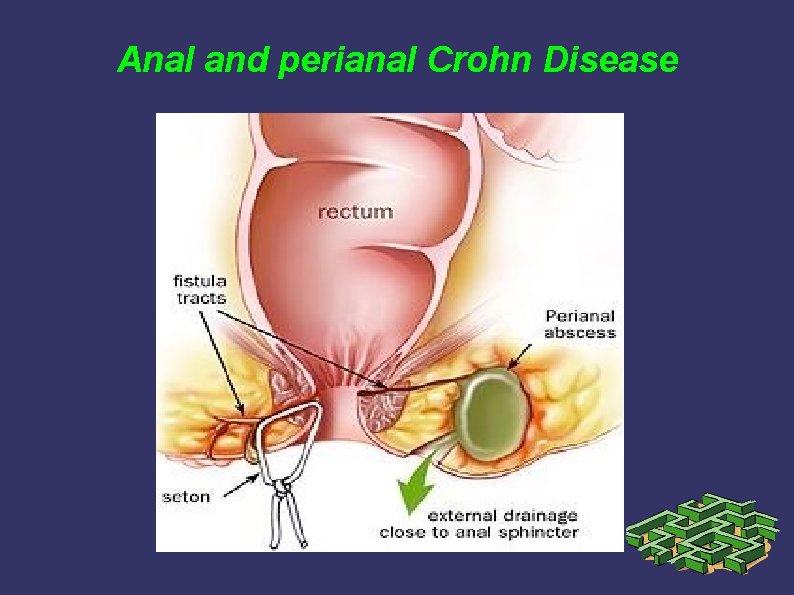 Anal and perianal Crohn Disease Anal and perianal Crohn Disease