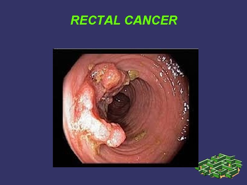 RECTAL CANCER RECTAL CANCER