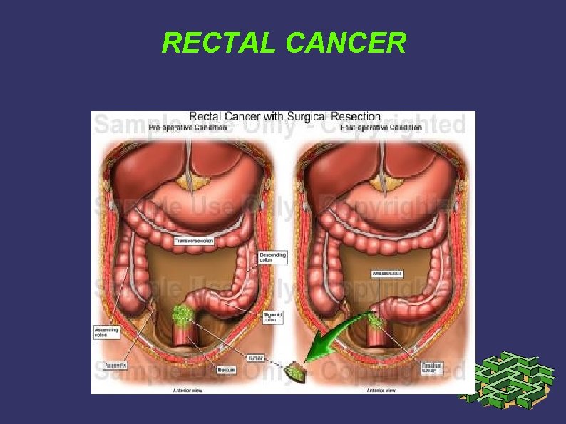 RECTAL CANCER RECTAL CANCER
