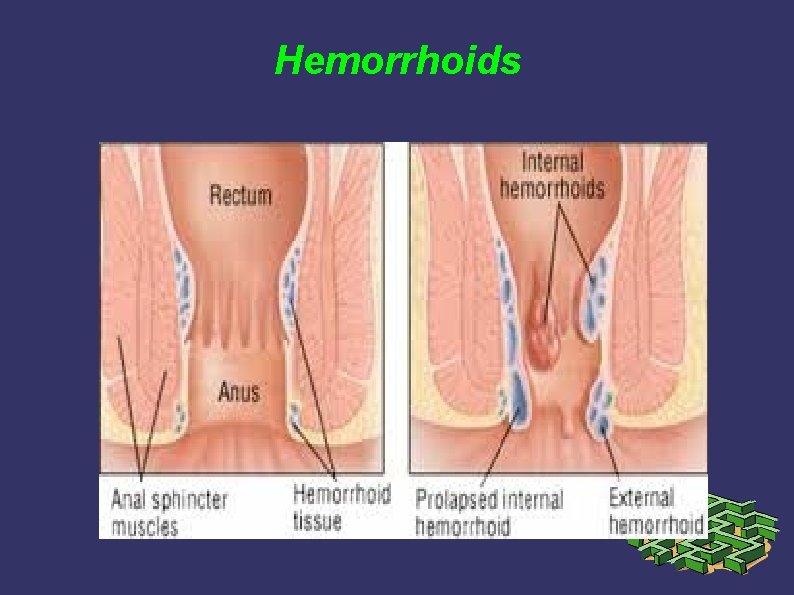 Hemorrhoids Hemorrhoids