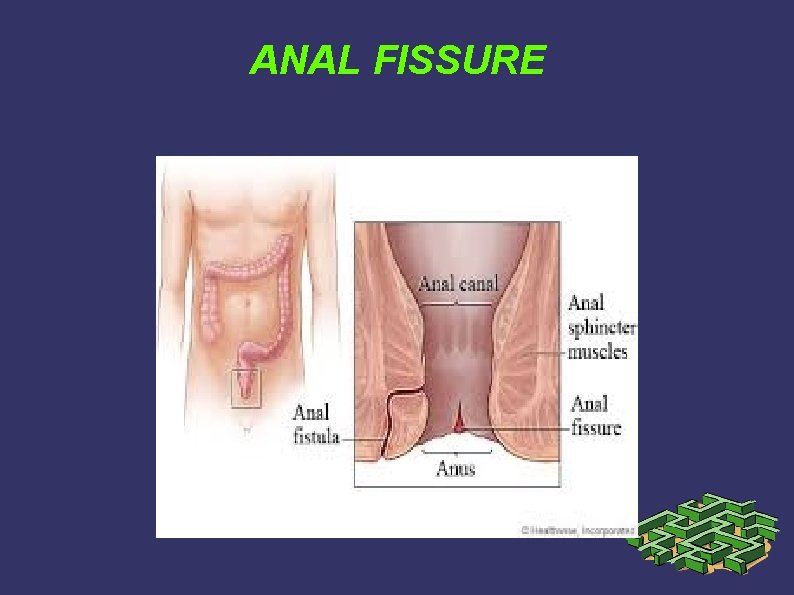 ANAL FISSURE ANAL FISSURE