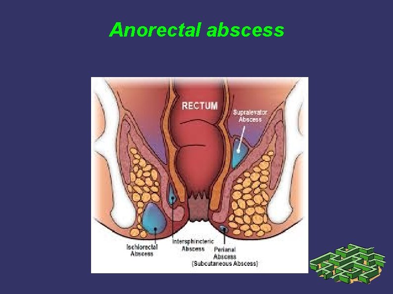 Anorectal abscess Anorectal abscess