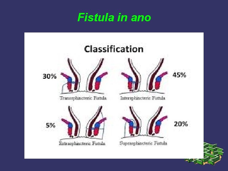 Fistula in ano Fistula in ano