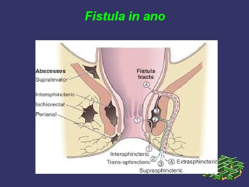 Fistula in ano Fistula in ano