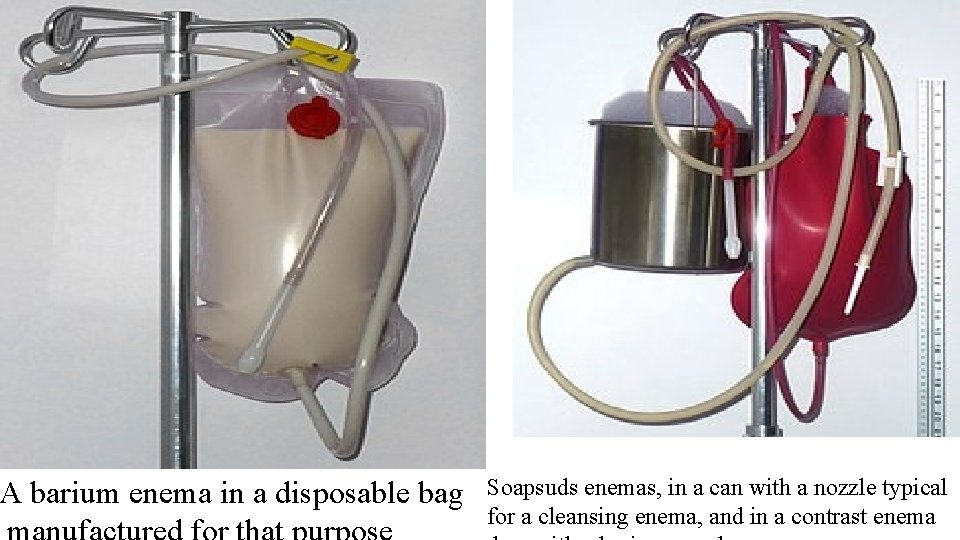 A barium enema in a disposable bag Soapsuds enemas, in a can with a