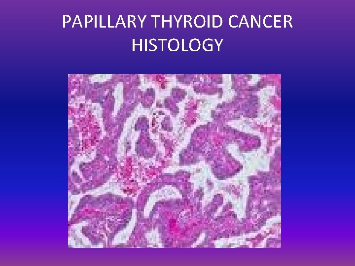 PAPILLARY THYROID CANCER HISTOLOGY 
