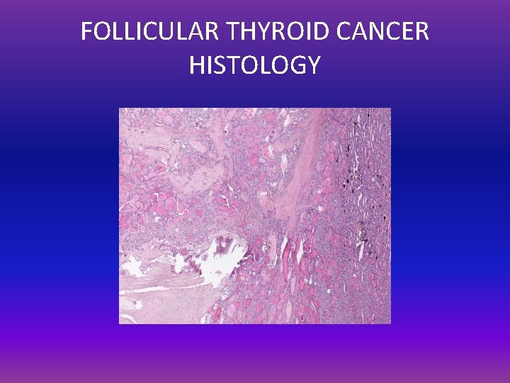 FOLLICULAR THYROID CANCER HISTOLOGY 