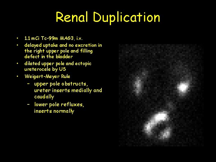 Renal Duplication • • 1. 1 m. Ci Tc-99 m MAG 3, i. v.