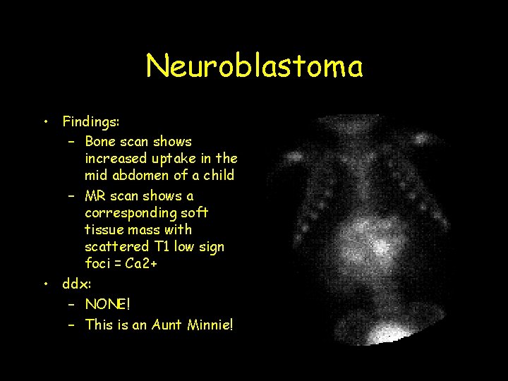 Neuroblastoma • Findings: – Bone scan shows increased uptake in the mid abdomen of