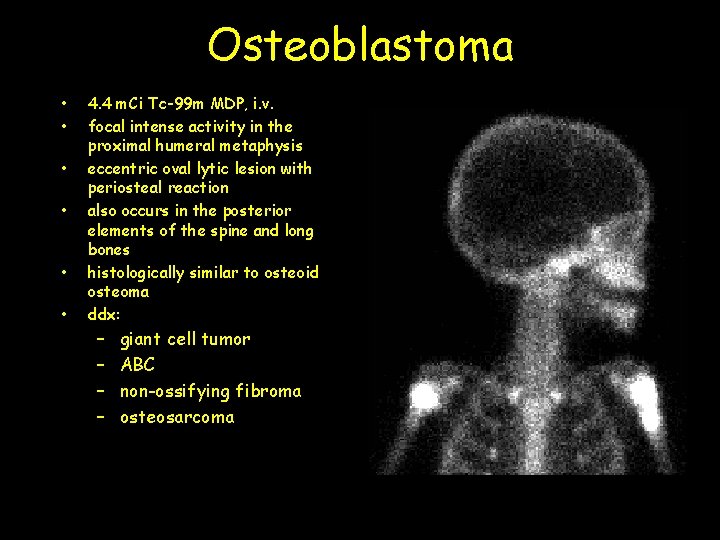 Osteoblastoma • • • 4. 4 m. Ci Tc-99 m MDP, i. v. focal