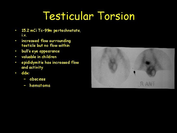 Testicular Torsion • • • 15. 2 m. Ci Tc-99 m pertechnetate, i. v.