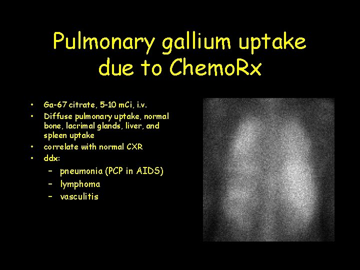 Pulmonary gallium uptake due to Chemo. Rx • • Ga-67 citrate, 5 -10 m.