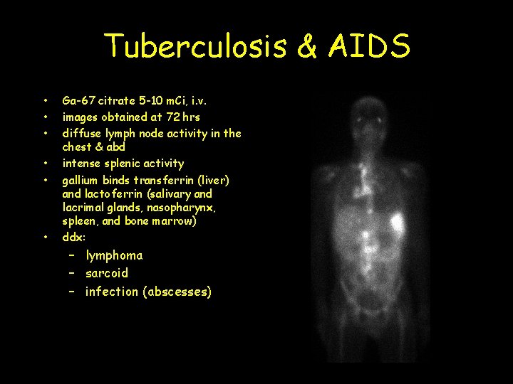 Tuberculosis & AIDS • • • Ga-67 citrate 5 -10 m. Ci, i. v.
