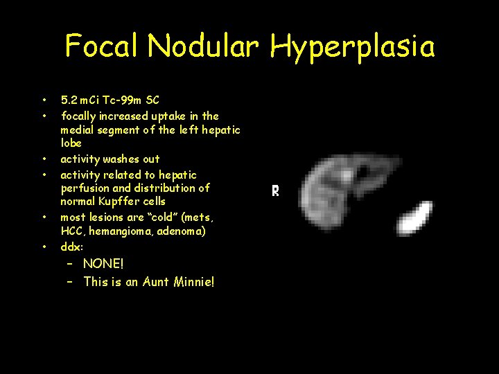 Focal Nodular Hyperplasia • • • 5. 2 m. Ci Tc-99 m SC focally