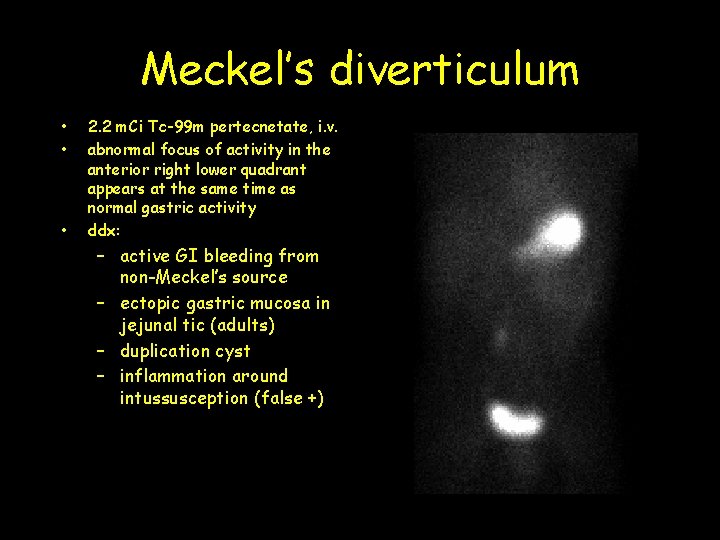 Meckel’s diverticulum • • • 2. 2 m. Ci Tc-99 m pertecnetate, i. v.