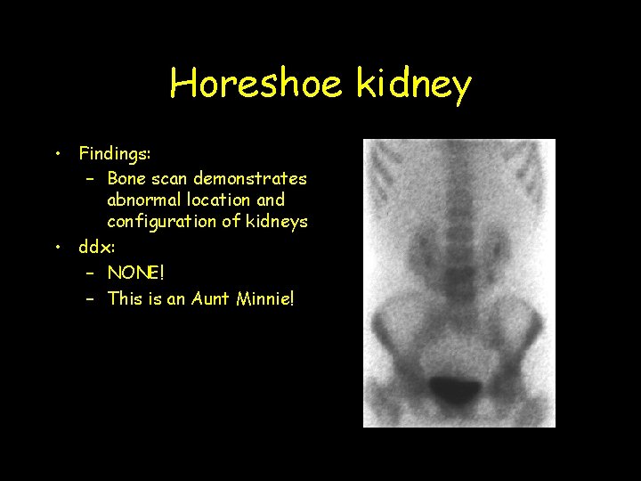 Horeshoe kidney • Findings: – Bone scan demonstrates abnormal location and configuration of kidneys