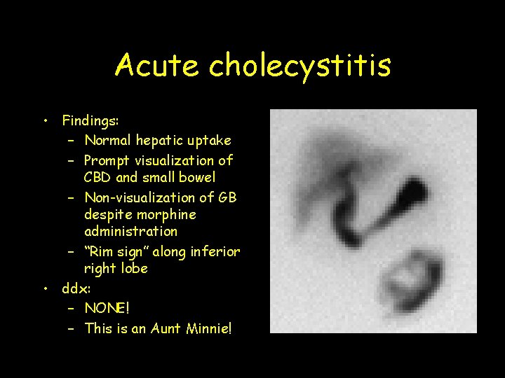 Acute cholecystitis • Findings: – Normal hepatic uptake – Prompt visualization of CBD and
