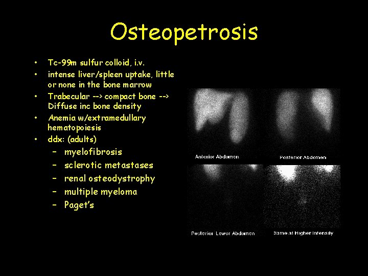 Osteopetrosis • • • Tc-99 m sulfur colloid, i. v. intense liver/spleen uptake, little