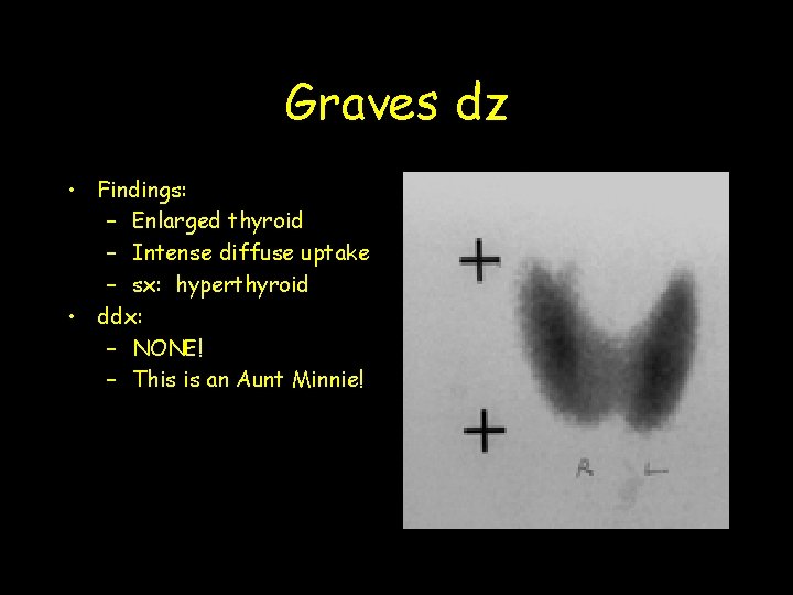Graves dz • Findings: – Enlarged thyroid – Intense diffuse uptake – sx: hyperthyroid
