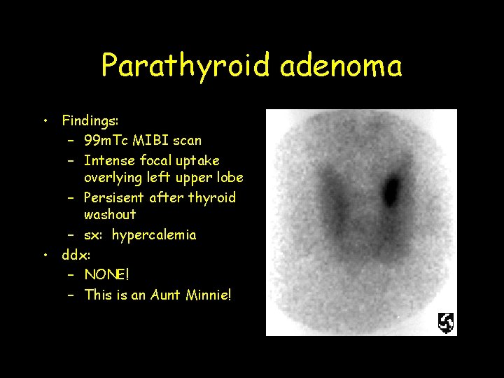 Parathyroid adenoma • Findings: – 99 m. Tc MIBI scan – Intense focal uptake