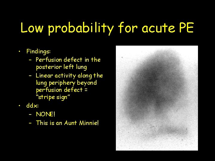 Low probability for acute PE • Findings: – Perfusion defect in the posterior left