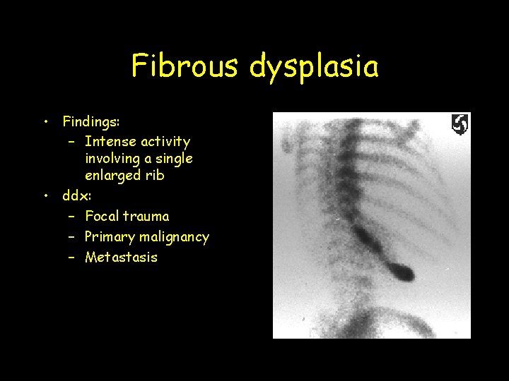 Fibrous dysplasia • Findings: – Intense activity involving a single enlarged rib • ddx: