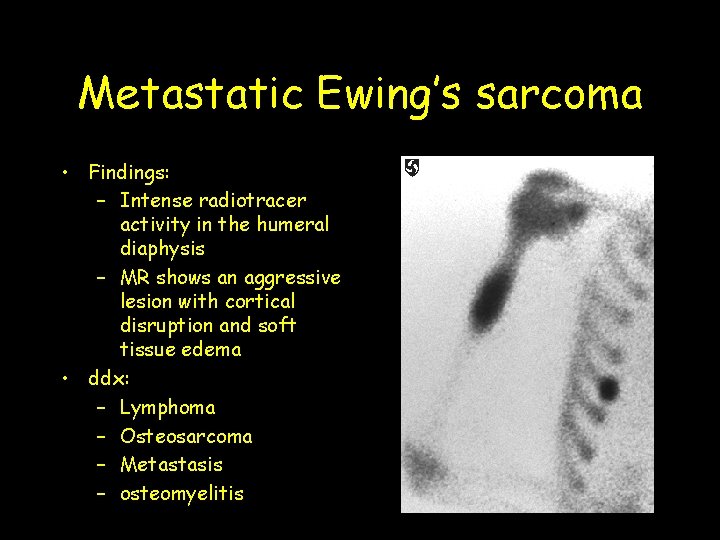 Metastatic Ewing’s sarcoma • Findings: – Intense radiotracer activity in the humeral diaphysis –