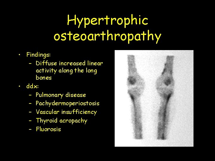 Hypertrophic osteoarthropathy • Findings: – Diffuse increased linear activity along the long bones •