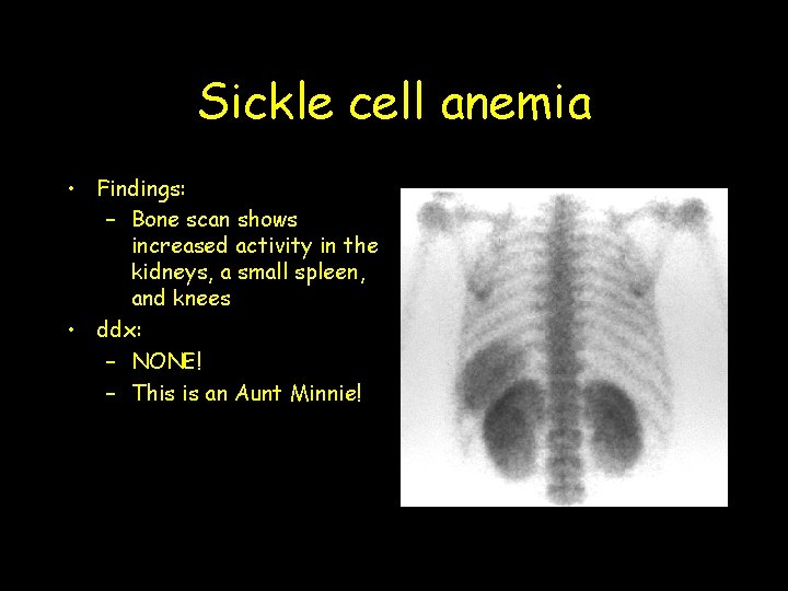 Sickle cell anemia • Findings: – Bone scan shows increased activity in the kidneys,