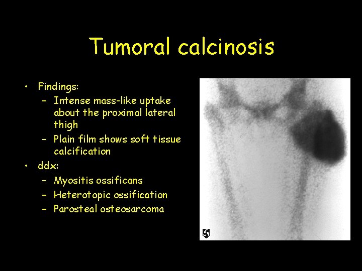 Tumoral calcinosis • Findings: – Intense mass-like uptake about the proximal lateral thigh –