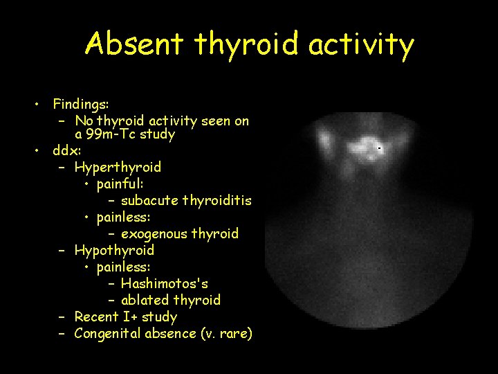 Absent thyroid activity • Findings: – No thyroid activity seen on a 99 m-Tc