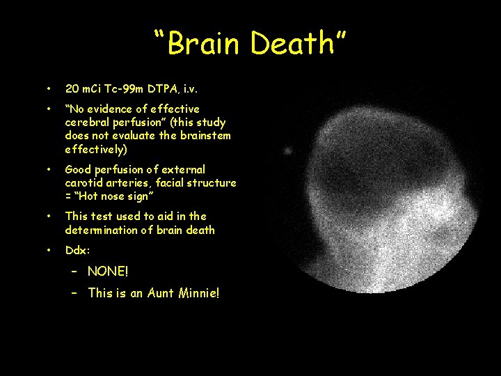 “Brain Death” • 20 m. Ci Tc-99 m DTPA, i. v. • “No evidence